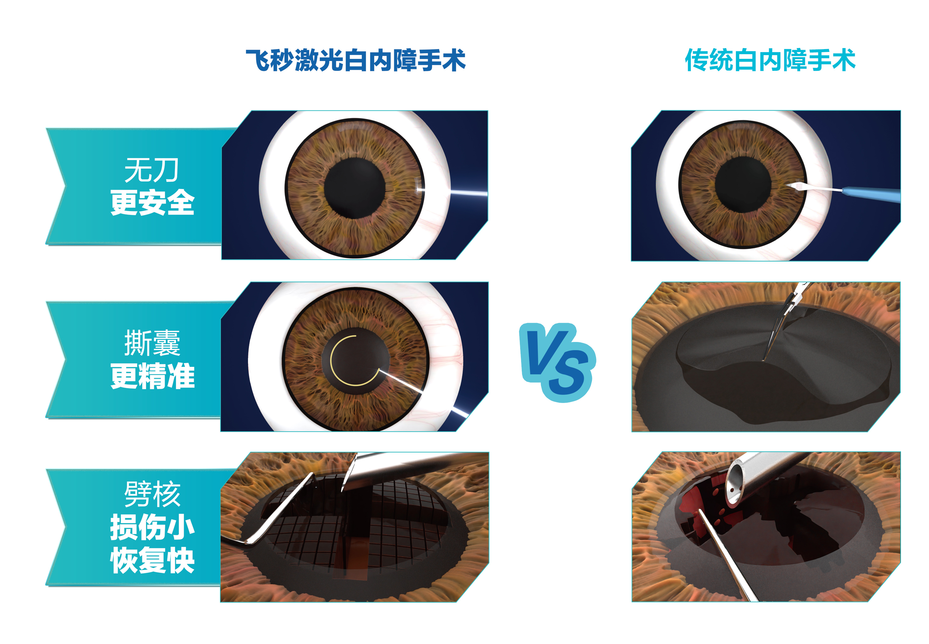 爱尔飞秒白内障，精准无刀更可靠
