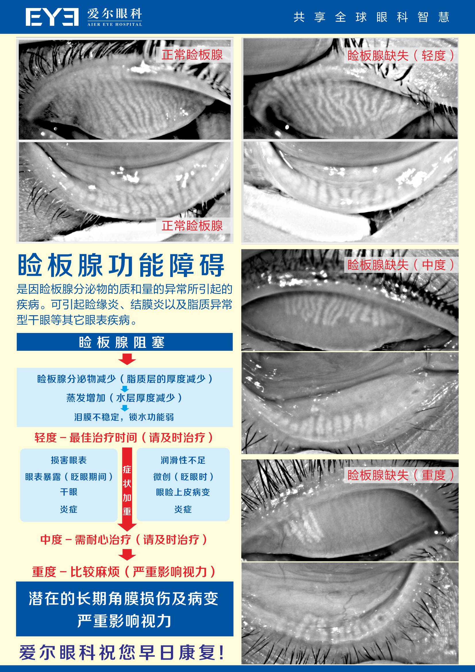 干眼-睑板腺(1)