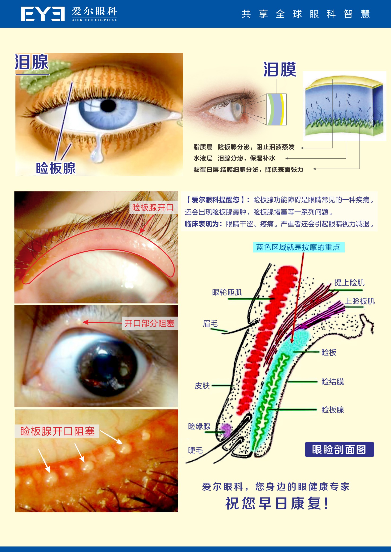 干眼-睑板腺1(1)